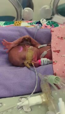 Pregnancy 26 Weeks Premature Pregnancy 35 Weeks Premature