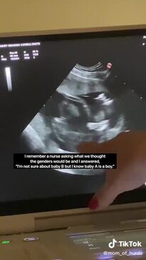 Twin Pregnancy Premature Twins 24 Weeks Twin Babies 36 Week