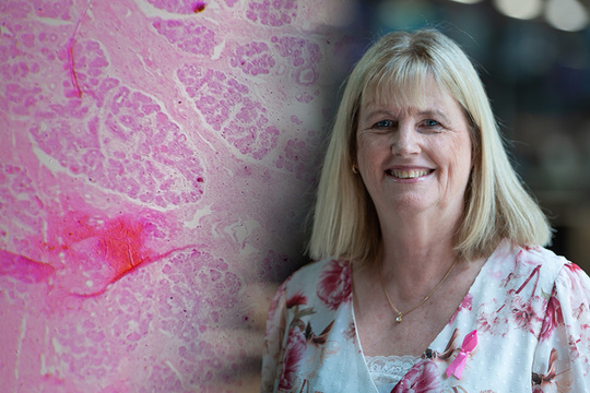 Breast cancer screening age limit raised: More NZ women to get