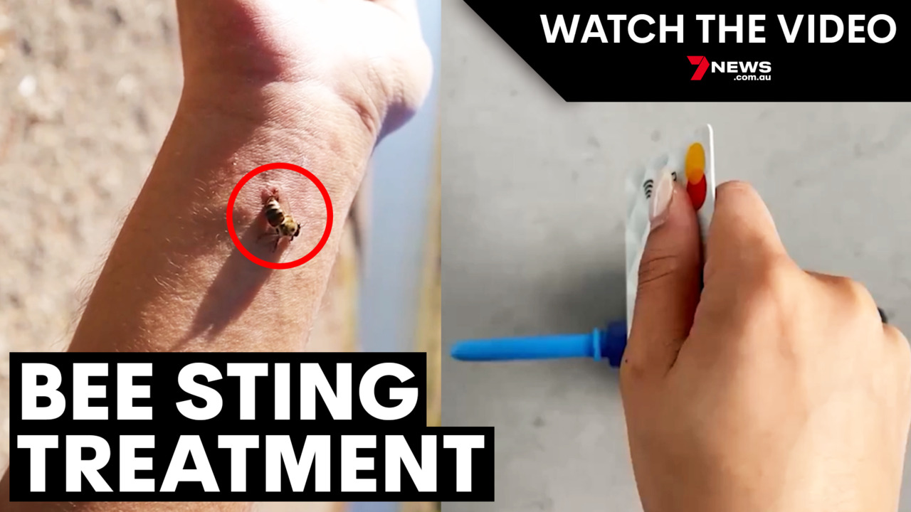 bee sting on finger treatment