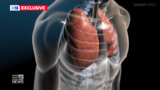 New weapon investigated for the treatment of lung cancer