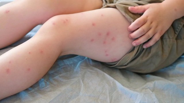 Measles Outbreak Spreads in Adelaide as Health Officials Issue Warning