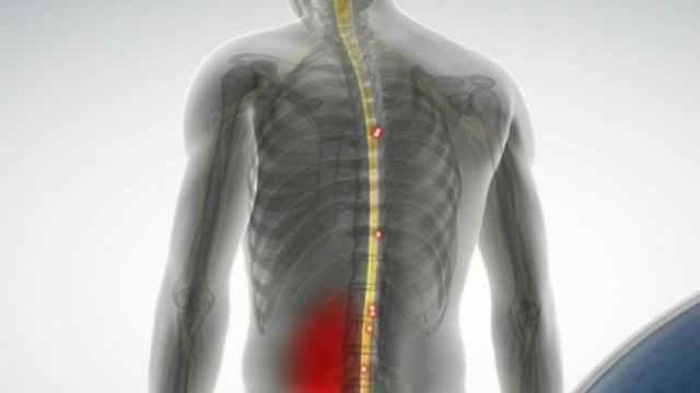 New Stimulator Delivers Back Pain Relief — Pain News Network