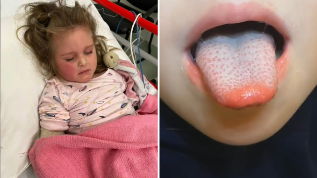 How to spot tell-tale scarlet fever rash as cases soar and 6 kids die in  Strep A outbreak