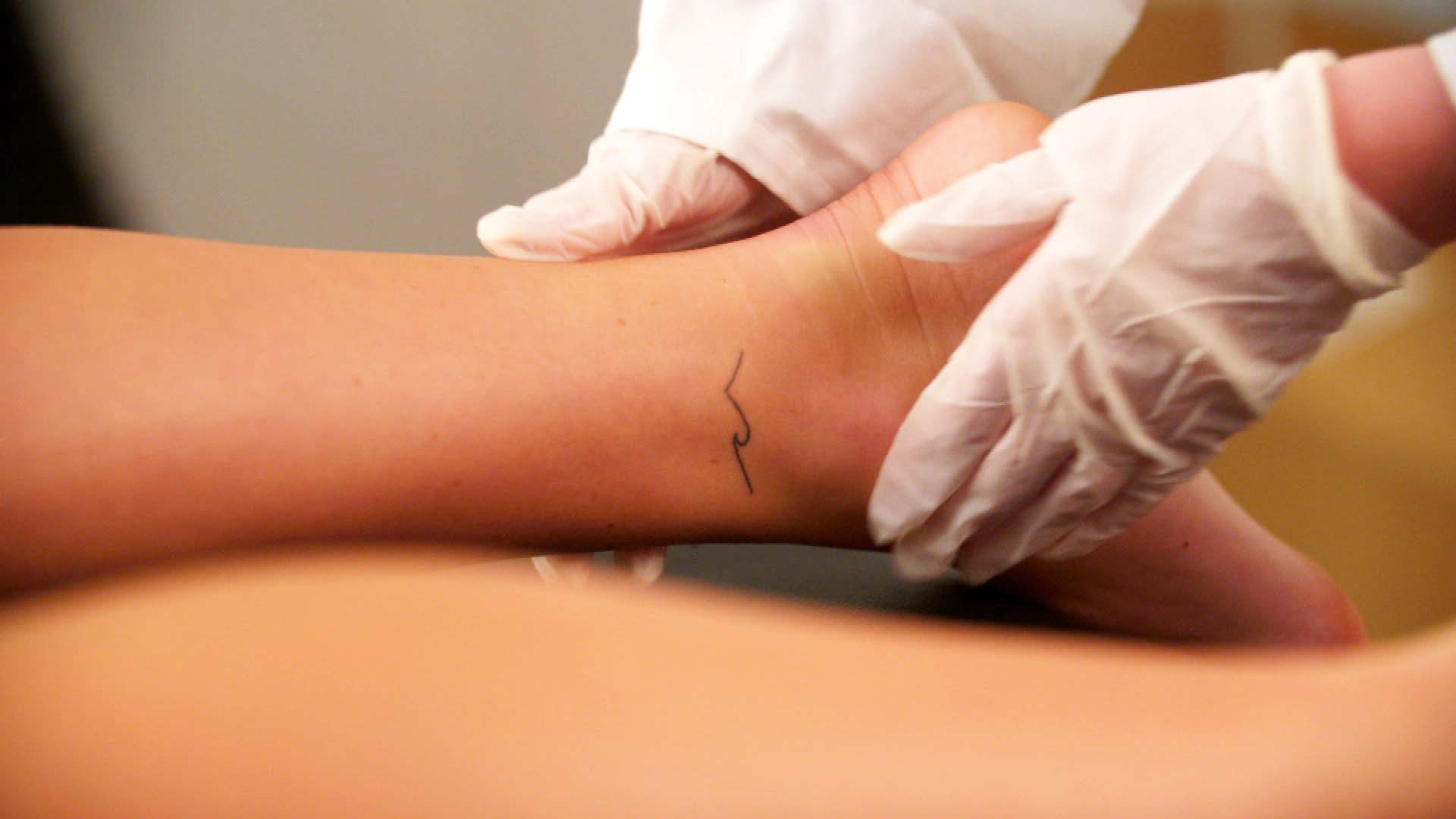 Hair removal clinic lasers woman's tattoo by mistake
